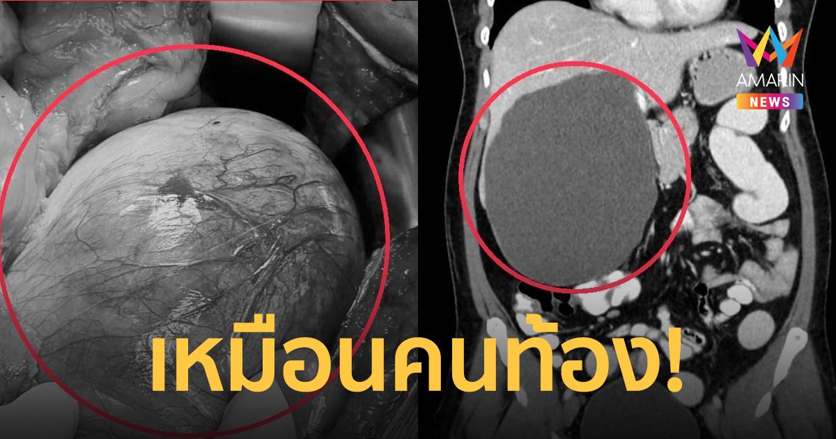 ช็อก! ผู้ป่วยท้องอืดกว่าปี ตรวจอีกทีเจอก้อนถุงน้ำในตับขนาด  20 ซม.