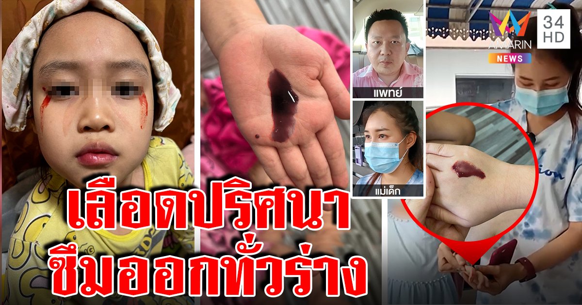 เด็ก 7 ขวบเลือดไหลออกตัวปริศนา สื่อรุดดูซึมทะลักออกมือ หมอแจงเกิดขึ้นยากมาก (คลิป)