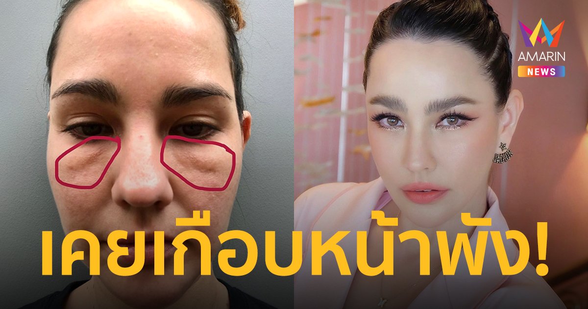 “แหม่ม วิชุดา” แชร์อุทาหรณ์เคยเกือบหน้าพัง! เพราะหมอฉีดไขมันใต้ตาผิดพลาด