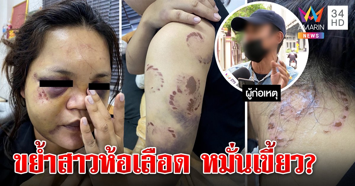 ล่าจากไลฟ์! หนุ่มป่วยจิตหมั่นเขี้ยวงับแขน-คอแฟน ทิ้งรอยรักฝังลึก สาวผวาขอตัดขาด (คลิป)
