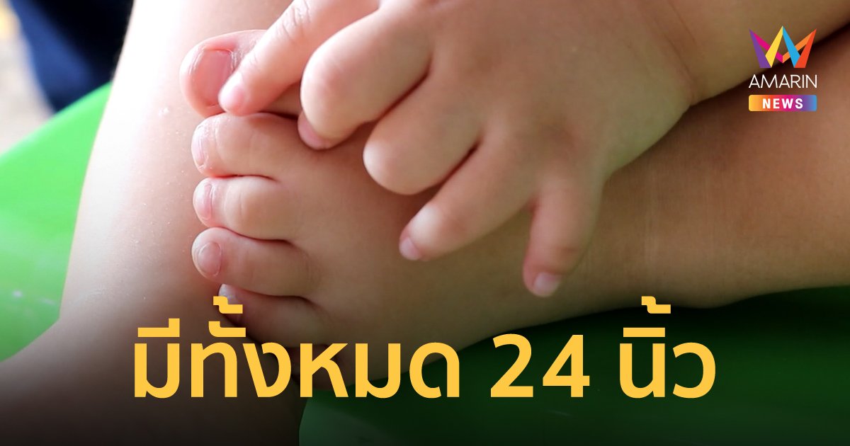 หนูน้อยวัย 2 ขวบ มีนิ้วมือ นิ้วเท้า ข้างละ 6 นิ้ว รวมเป็น 24 นิ้ว