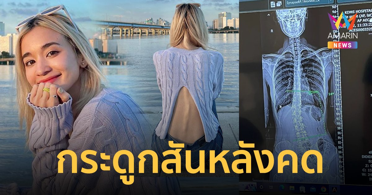 "ส้ม มารี" โพสต์เล่า กระดูกสันหลังคด หมอยืนยัน 14 องศาไม่อันตราย