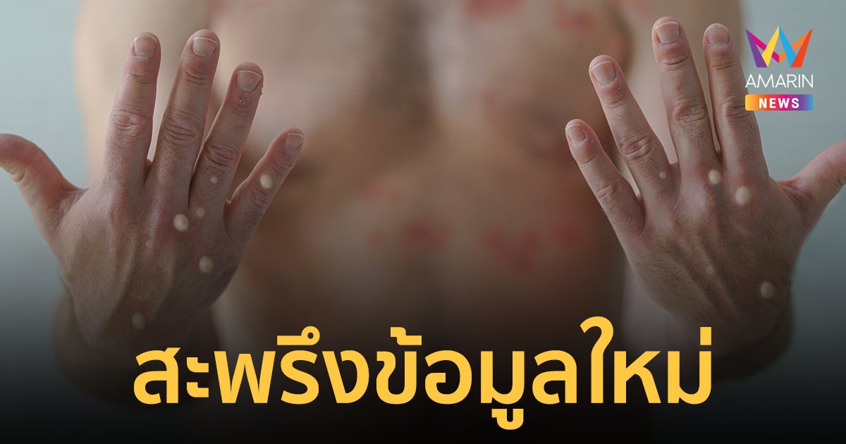 ข้อมูลใหม่ "ฝีดาษลิง" ชี้! ตำราเล่มเก่าอาจใช้ไม่ได้สายพันธุ์ปัจจุบัน