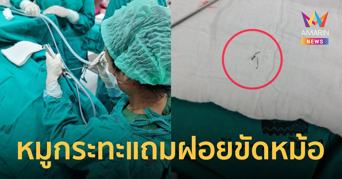 หมอเตือน คนไข้กินหมูกระทะ เจอฝอยขัดหม้อแทงในลำคอ ต้องหามเข้าห้องผ่าตัด
