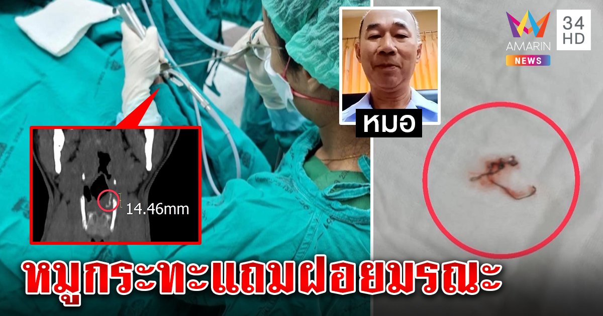 อึ้ง! กินหมูกระทะแถมฝอยขัดหม้อติดคอ หมอเร่งผ่าหลอดลมเผยช่วยไม่ทันอาจตาย (คลิป)