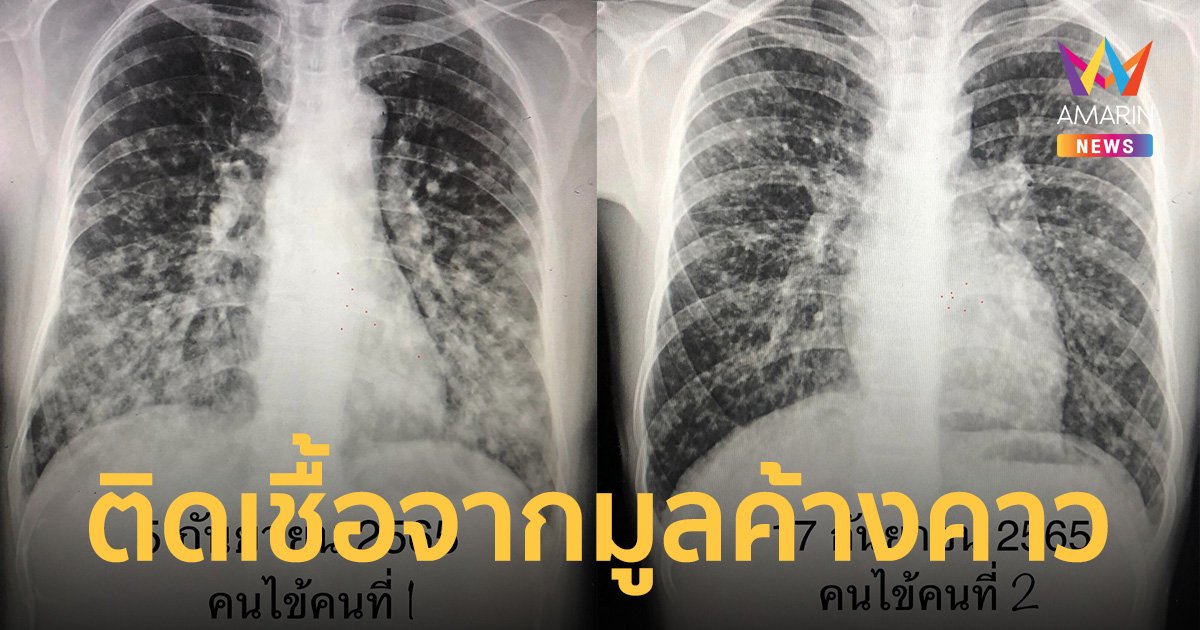 หมอมนูญ เผย คณะเดินป่าป่วย ฮิสโตพลาสโมซิส หลังมุดโพรงต้นไม้ชมค้างคาว