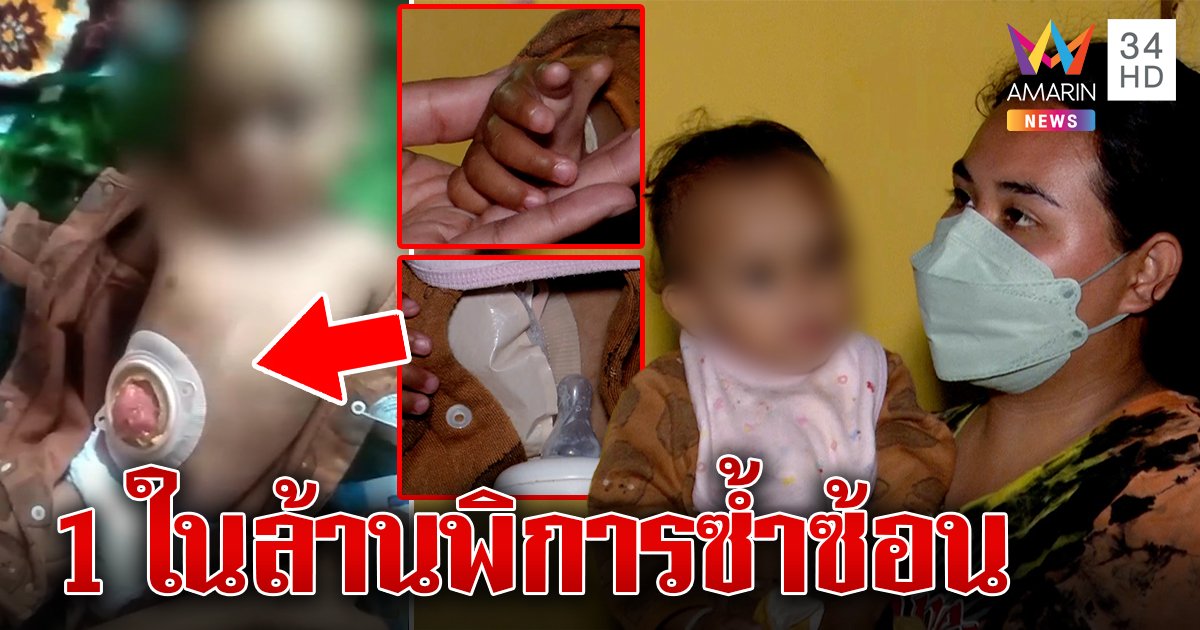 วอนช่วยน้องใบบุญเด็กพิการ 11 นิ้ว ไร้หู-รูทวาร หมออึ้งมี 2 เพศโรครุม (คลิป)