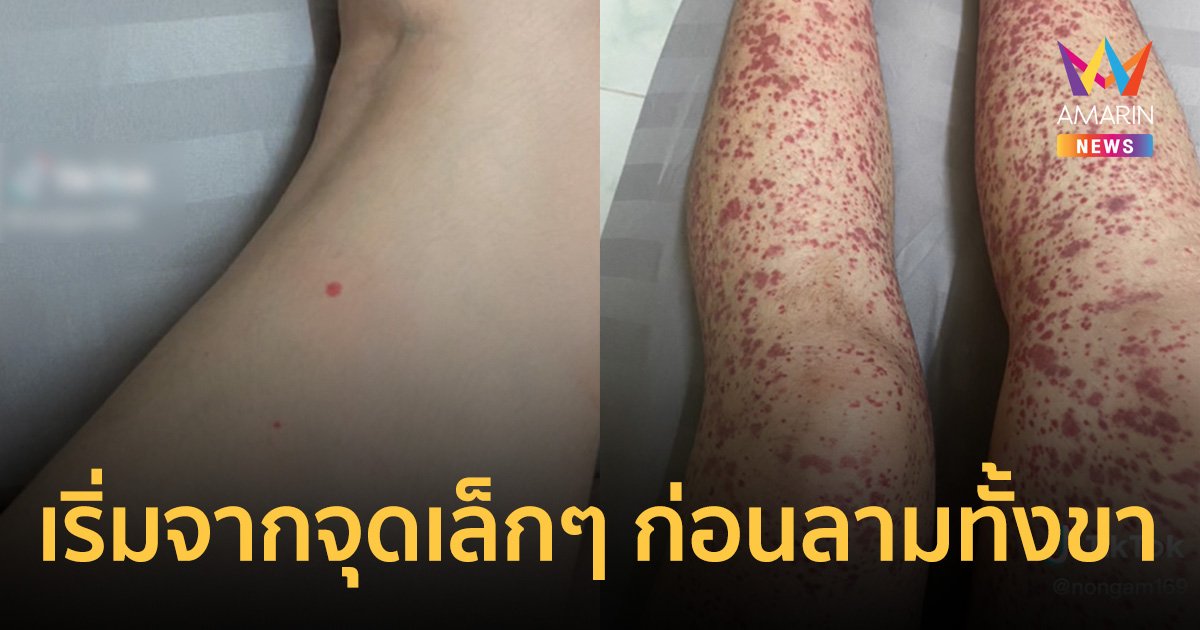 สาวแชร์ประสบการณ์ "เส้นเลือดอักเสบ" จากจุดแดงเล็กๆ ก่อนลามทั้งขา