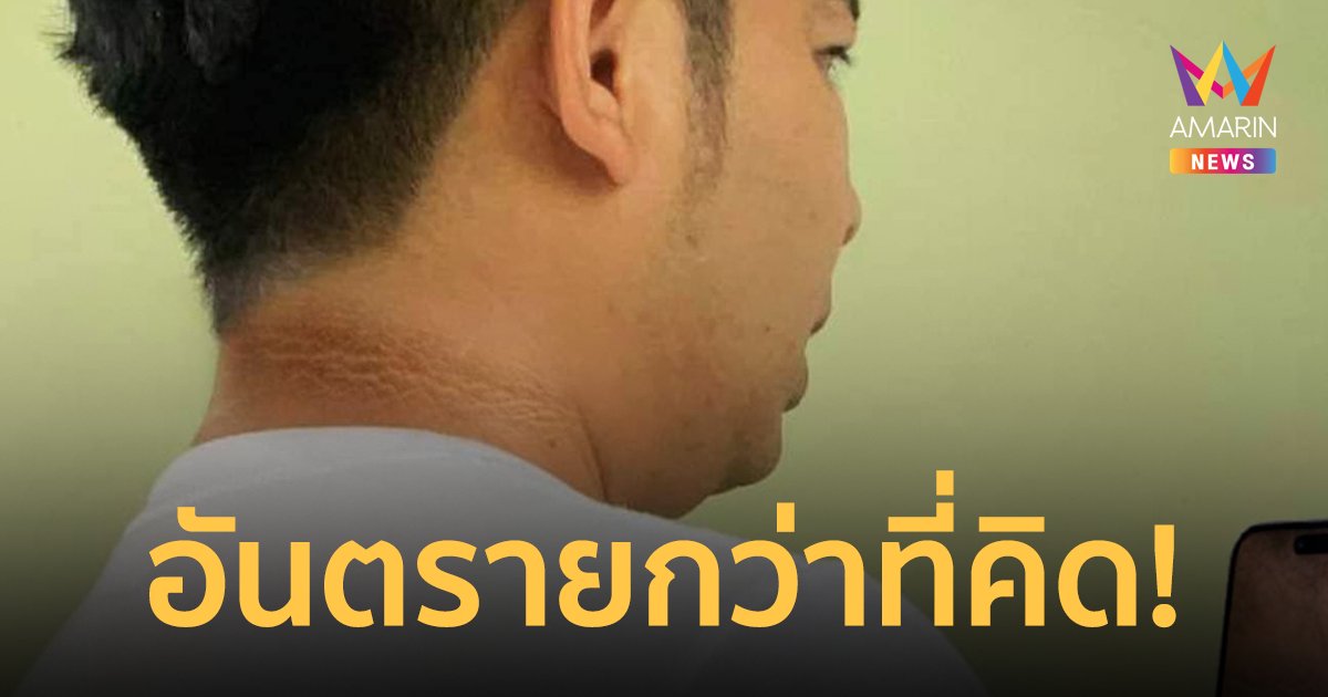 เช็กด่วน! หลังคอดำอาจไม่ใช่ขี้ไคล อาจเป็นสัญญาณเตือนของเบาหวาน-มะเร็ง