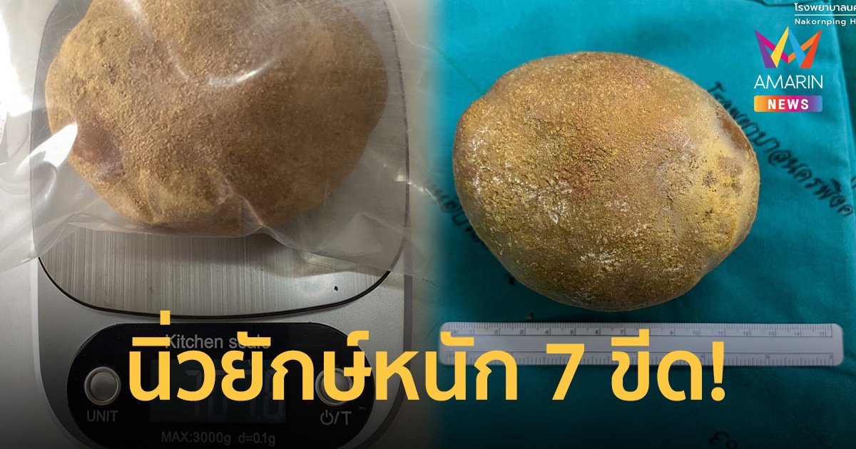 ผงะ! ลุงปวดท้องน้อยหลายเดือน ไปหาหมอตรวจเจอ "นิ่ว"ก้อนโตหนัก 7 ขีด