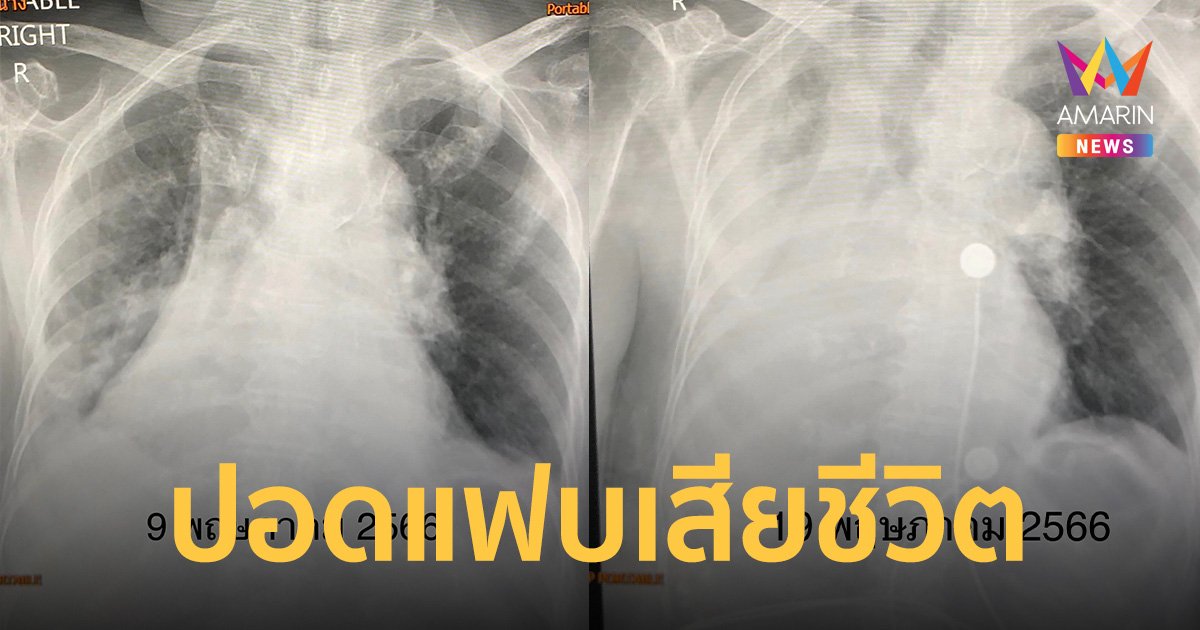 เจอ 2 ราย! ผู้ป่วยโควิด พบเสมหะอุดหลอดลม ทำปอดแฟบ ก่อนเสียชีวิต 1 ราย