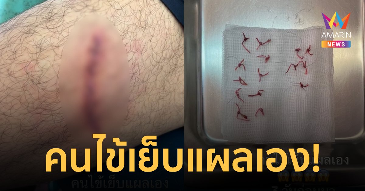 หมอช็อก! คนไข้เย็บแผลเองก่อนมาหาหมอ 3 วัน ชาวเน็ตเมนต์ "อย่าหาทำ"