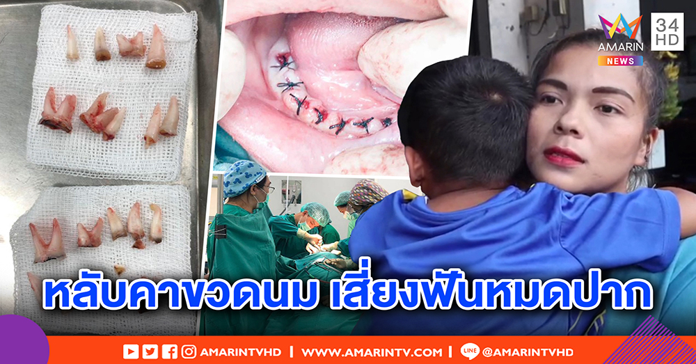 แม่รับผิด หมอถอนฟันลูก 4 ขวบ 18 ซี่ เหตุปล่อยขวดนมคาปาก ตามใจจนฟันผุ (คลิป)