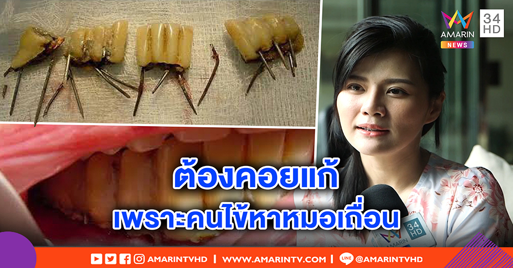 หมอมิ้นท์ เตือนภัยทำรากฟันเทียมเถื่อนเสี่ยงเน่า อย่าเห็นแก่ราคาถูก ปัดแย่งอาชีพใคร (คลิป)