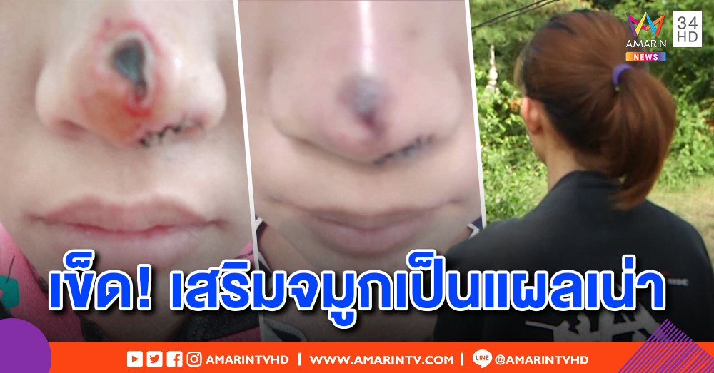 สาวช้ำ เสริมจมูกครั้งแรกอักเสบแผลเป็นรู ร้องขอเงินคืนแต่คลินิกไม่ยอม อ้างมีลายเซ็นพร้อมให้กลับไปแก้