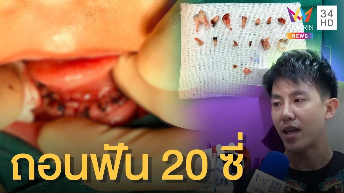 อุทาหรณ์! เด็ก 4 ขวบ ฟันน้ำนมผุลุกลาม หมอถอน 20 ซี่ (คลิป)