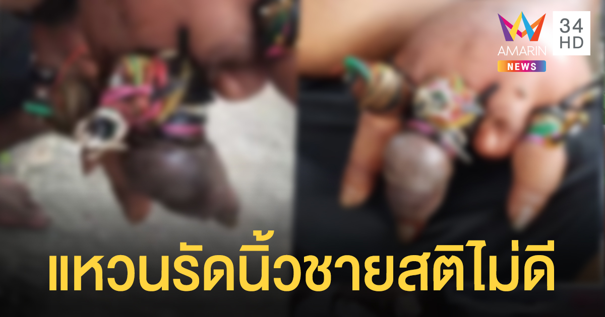 ร้องโซเชียลช่วย หนุ่มสติไม่ดีสวมแหวนเต็มนิ้ว รัดจนบวมเป่ง