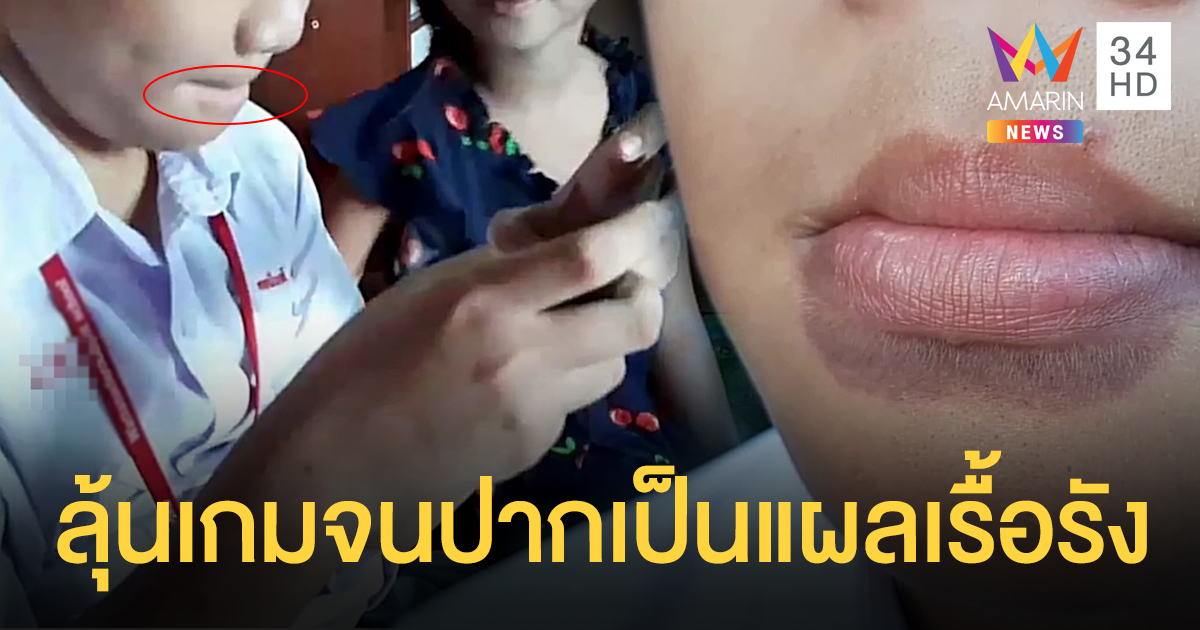 เตือนผู้ปกครอง! เด็กติดเกม นั่งเม้มปากเป็นเวลานาน จนเกิดแผลเรื้อรัง