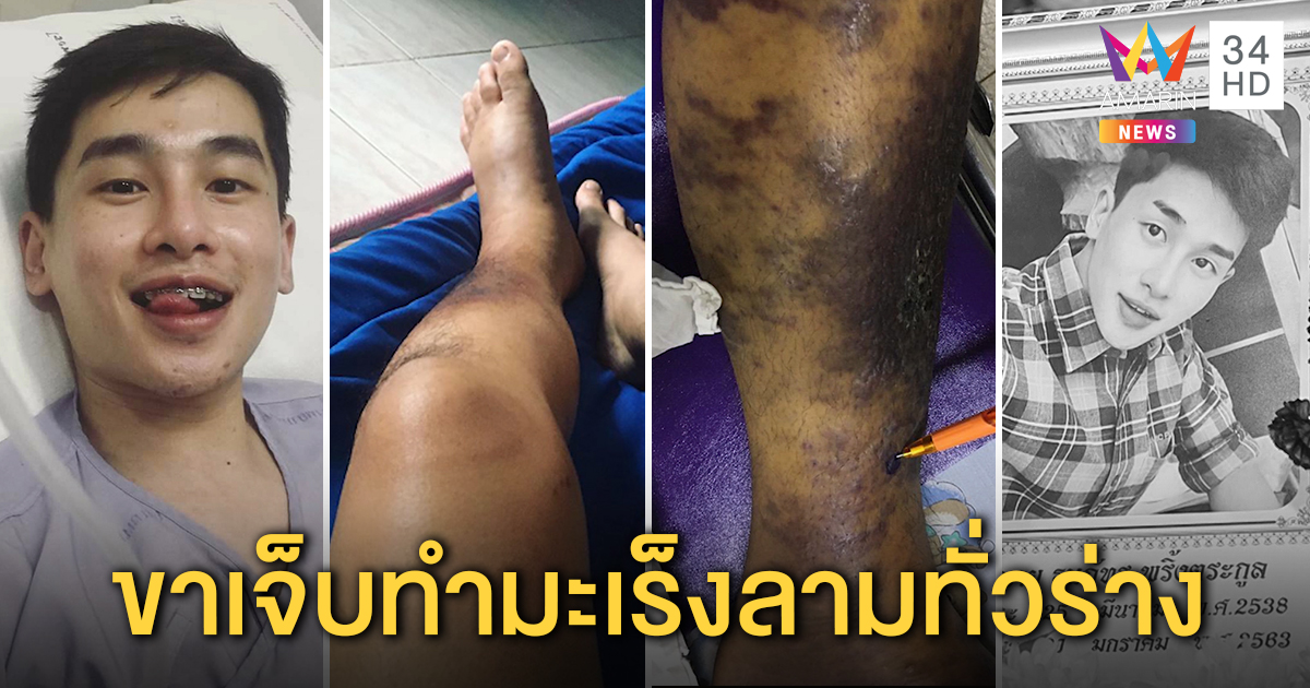 ช็อก! ดาราหนุ่มหนังวายดับ ถูกถังไอติมทับขาเชื้อมะเร็งลาม พ่อใจสลายจับมือลา (คลิป)