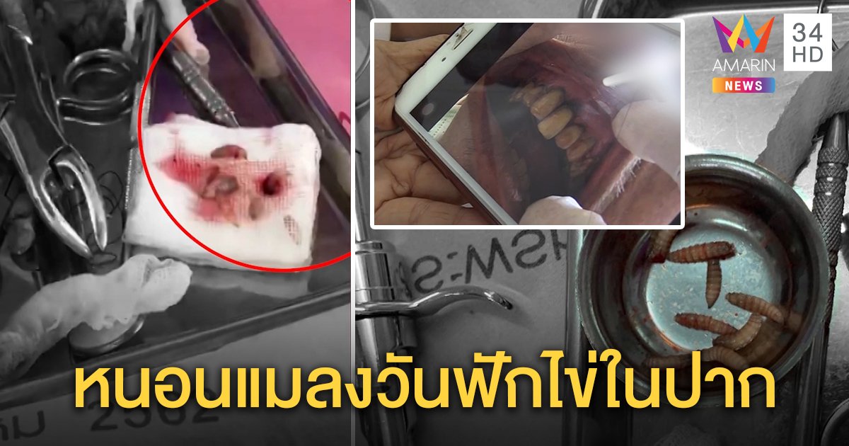 หมอฟันสุดอึ้งนึกว่ามีแต่ในตำรา พบรังหนอนแมลงวันเต็มปากผู้ป่วยติดเตียง ผ่าเจอ 15 ตัว (คลิป)