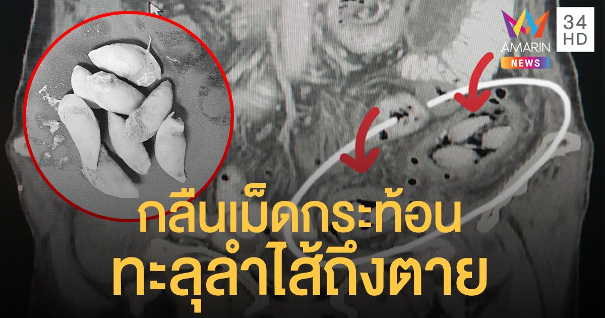 หมอเตือน! กลืน "เม็ดกระท้อน" อาจทะลุลำไส้ถึงตาย