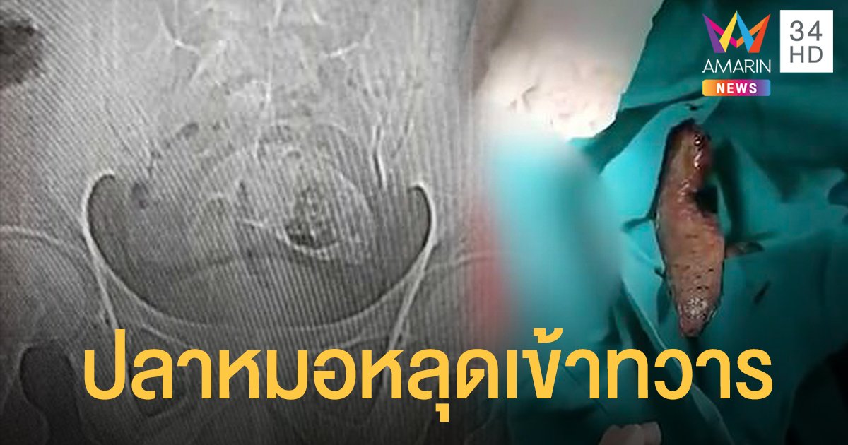 แพทย์ผ่าตัดช่วยหนุ่มจีนเผลอนั่งทับ "ปลาหมอ" ผลุบเข้าทวารหนัก