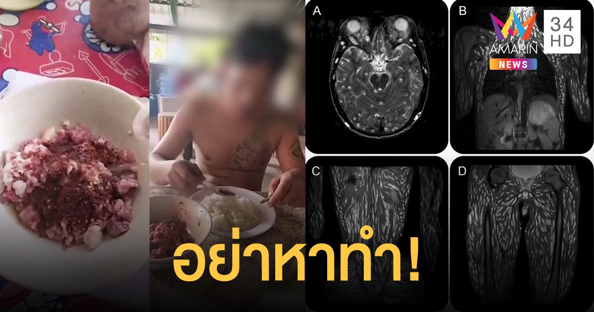 เตือน "ห้ามกินหมูดิบ" เสี่ยงอันตราย เจอพยาธิตืดหมูกระจายเต็มตัว