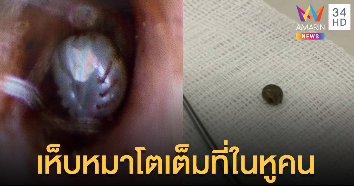 สยอง! เห็บหมาในหูคน ดูดเลือดจนตัวโต พร้อมวางไข่รุ่นต่อไป
