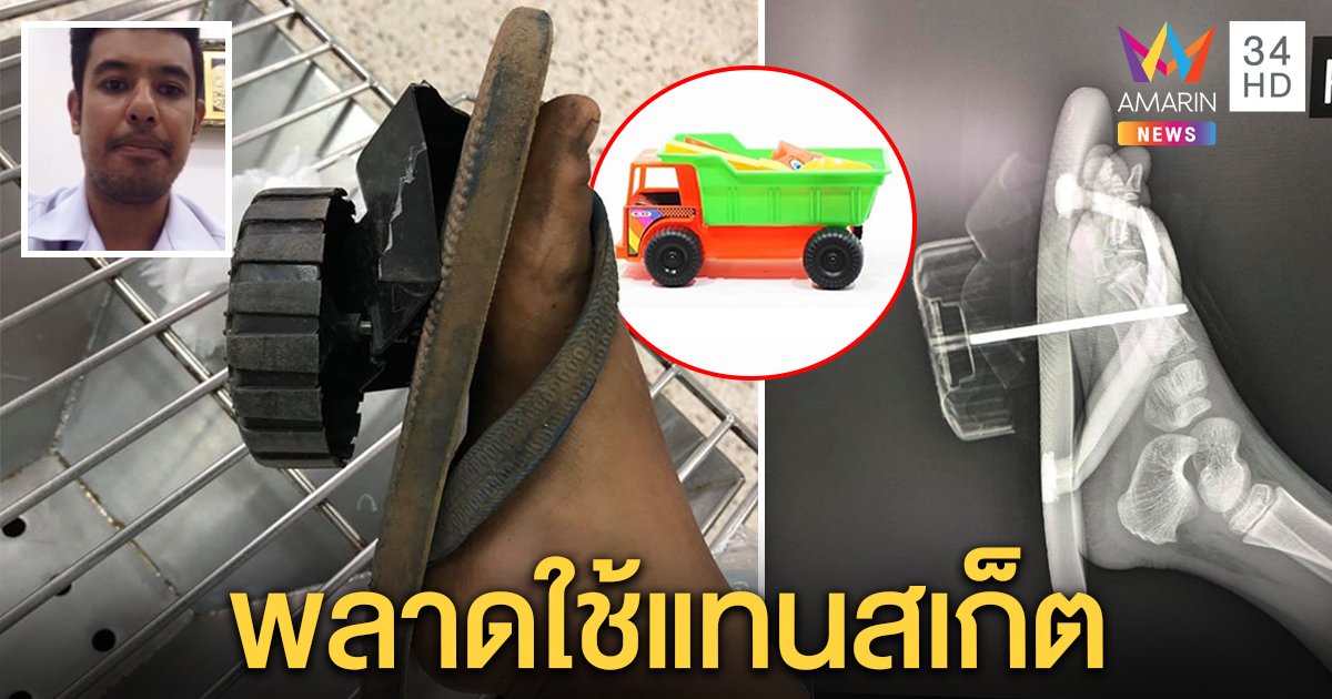 เปิดภาพเอกซเรย์สุดหวาดเสียว เด็ก 6 ขวบเหยียบรถของเล่น แกนล้อเหล็กเสียบทะลุเท้า (คลิป)