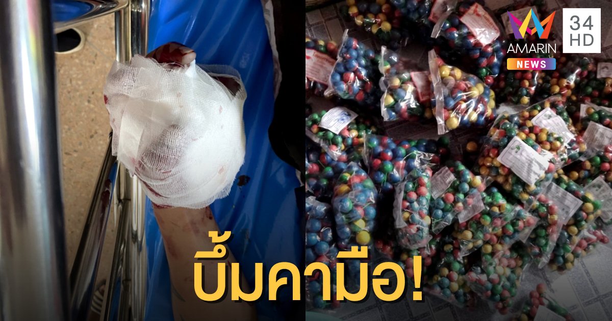 ประทัดลูกบอลบึ้มใส่มือจนเละ นิ้วขาด กระดูกแตก