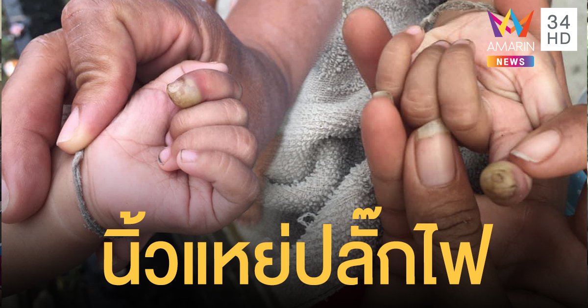 อุทาหรณ์! เด็ก 7 เดือนซนนิ้วแหย่ปลั๊กถูกไฟช็อต หมอเผยอาจต้องตัดนิ้ว