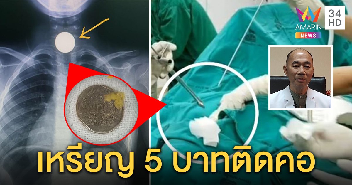 เด็ก 6 ขวบอมเหรียญ 5 บาทเล่นติดคอ แพทย์ผ่าตัดช่วยทัน ชี้ติดหลอดลมถึงตาย (คลิป)