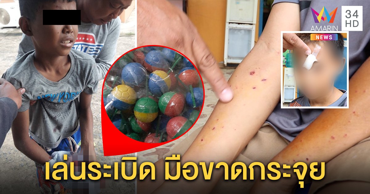 เด็ก 12 เล่นยัดระเบิดปิงปองใส่ขวด พลาดบึ้มมือขาด เพื่อนเล่านาทีตาหวิดบอด (คลิป)