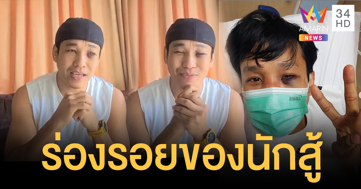"เอ็กซ์ ธิตินันท์" ยังไหว! เผยภูมิใจกับร่องรอยนักสู้บนสังเวียน หลังเบ้าตาแตก-จมูกกระดูกอ่อนแตก 2 ข้าง