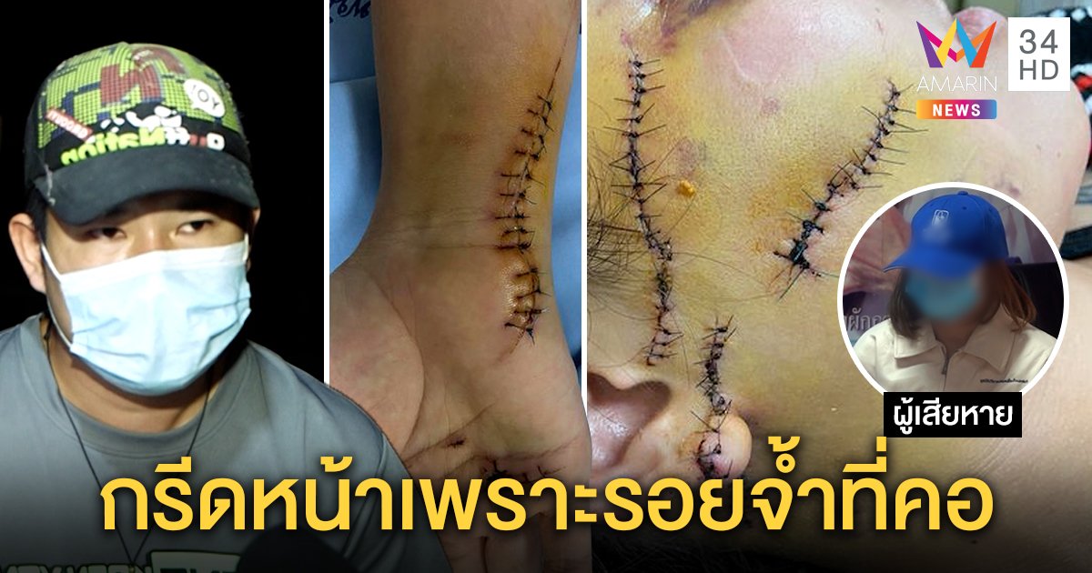 ผัวฉุนคัตเตอร์กรีดหน้าเมีย 91 เข็ม ฉุนเห็นรอยจ้ำที่คอ เหยื่อพึ่งปวีณาลากคอ (คลิป)