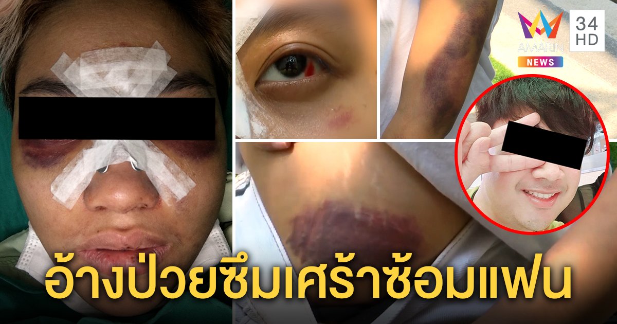 น่วมทั้งร่าง! สาวผวาแฟนซ้อมโหดรัดคอ-ทุบหัว อ้างซึมเศร้า หอบผ้าหนียังขู่ทำเสียโฉม (คลิป)
