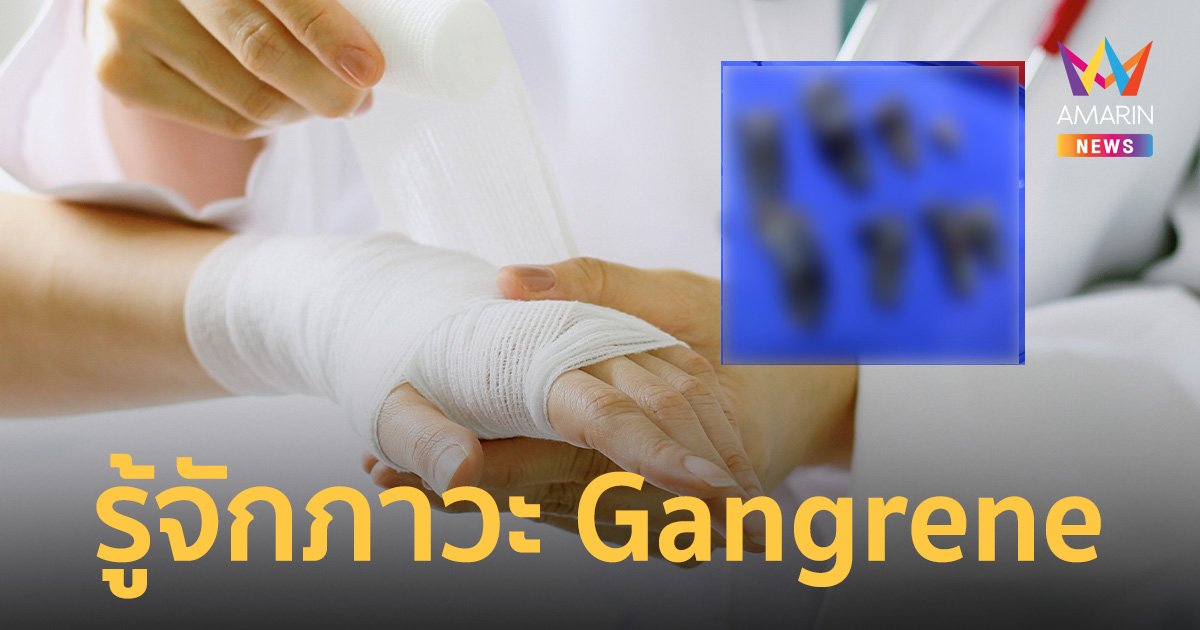 Gangrene หรือ เนื้อตายเน่า ภาวะที่เกิดจากเนื้อเยื่อบางส่วนขาดเลือด-ตาย