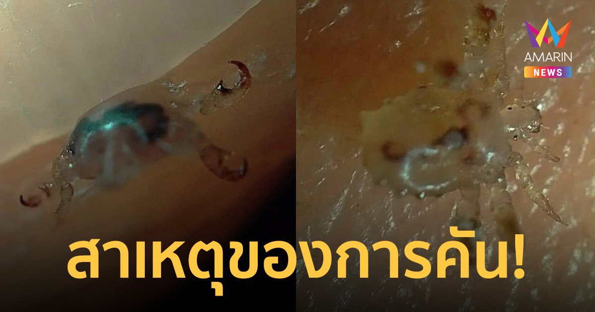 หมอเตือน หากคันจุดลับ ให้ลองก้มดู อาจเจอ "โลน" ดูดเลือดเป็นอาหาร