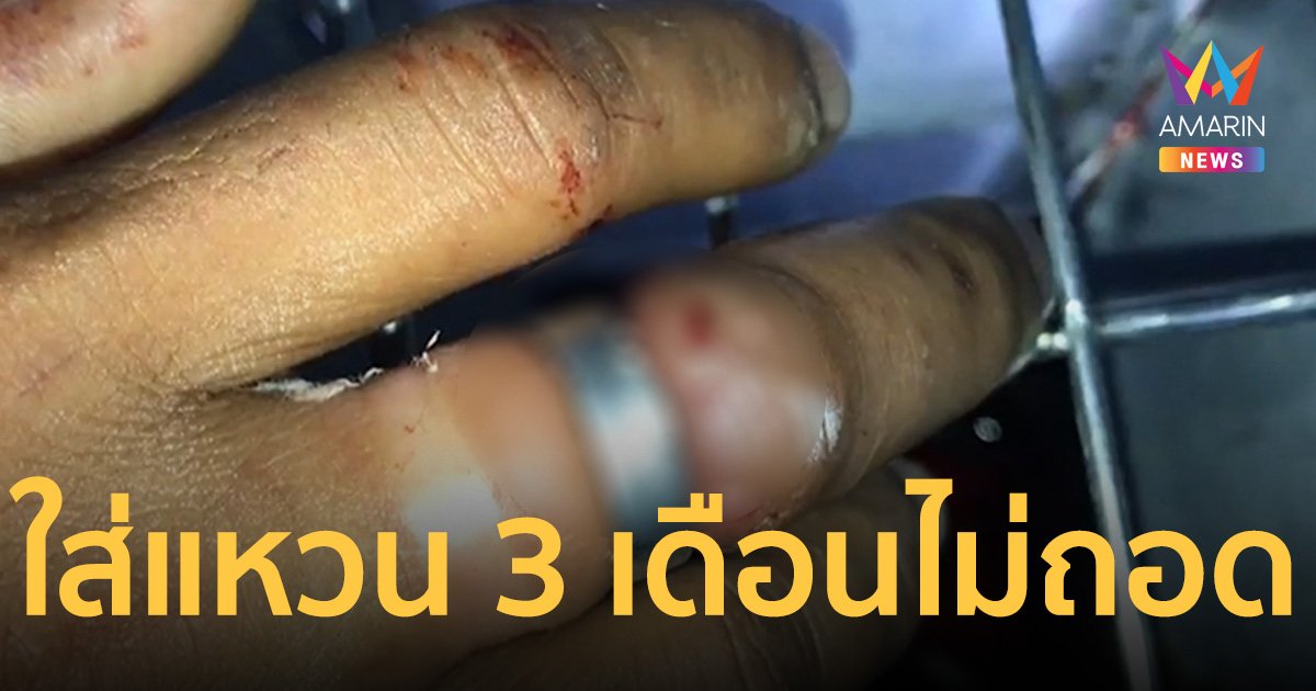 3 เดือนไม่เคยถอด! กู้ภัย เร่งช่วยเหลือหนุ่ม ใส่แหวนรัดจนนิ้วบวมเป่ง