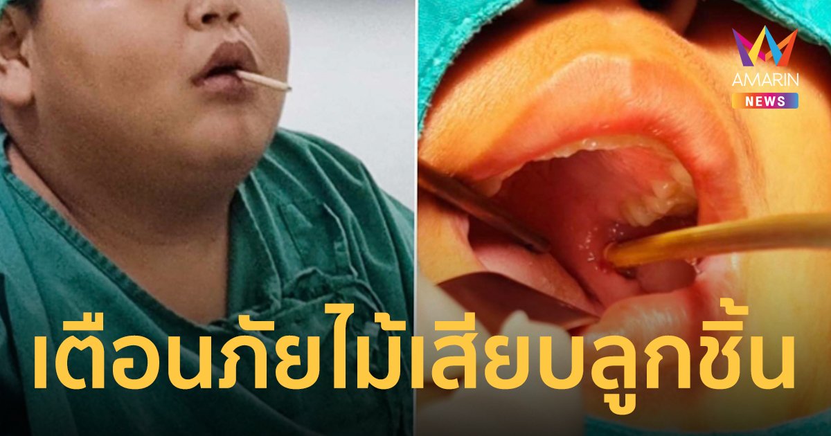 เตือนภัย ! ไม้เสียบลูกชิ้น ห้ามดึงออกเองเด็ดขาด