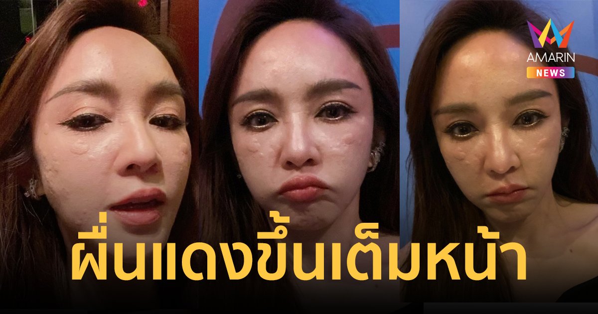 "เป้ย ปานวาด" แพ้แอลกอฮอล์รุนแรง ผื่นแดงขึ้นเต็มหน้า