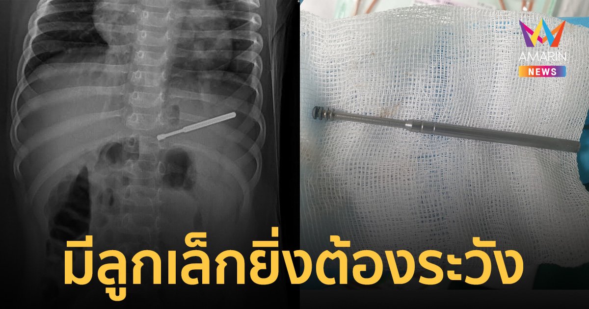 2 ขวบ ปอดบวม หมอเอ็กซเรย์เจอตัวการอันเบ้อเร่อ อุทาหรณ์ลูกหลานยังเล็กยิ่งต้องระวัง