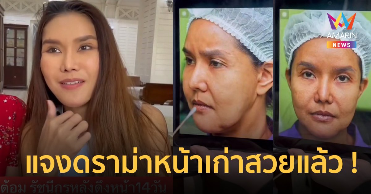 “ต้อม รัชนีกร” เผยหน้าก่อนศัลยกรรม แจงดราม่าดึงหน้าตึงเกินเหมือน “แอนนา”