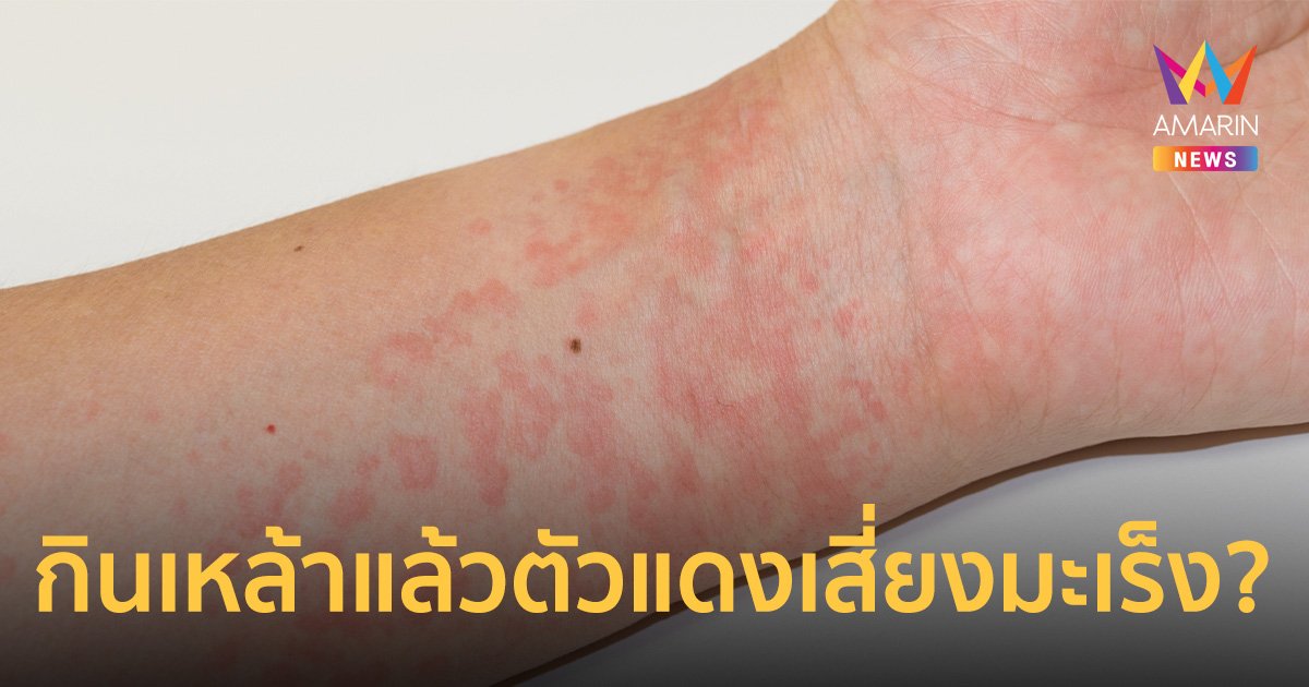 ไขข้อสงสัย? ดื่มเหล้าแล้วตัวแดง เสี่ยงป่วยมะเร็งบางชนิดมากขึ้น จริงหรือไม่