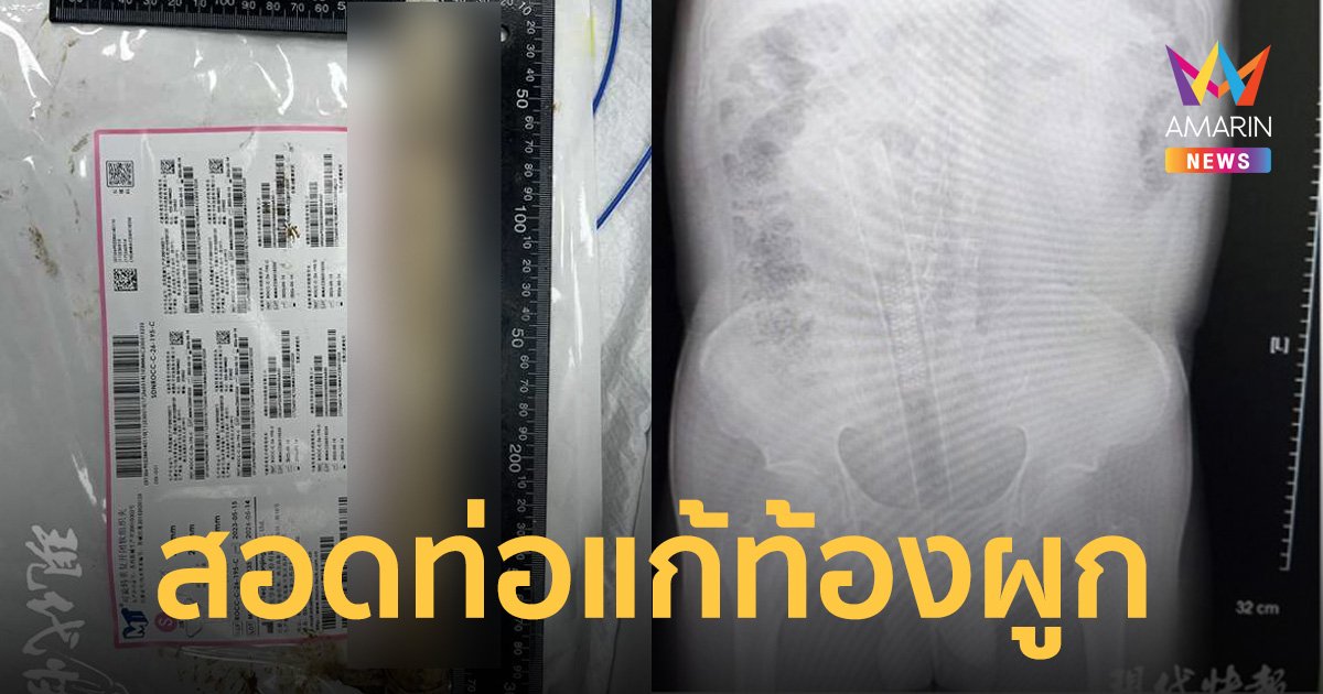 ลุงท้องผูก ใช้ท่อ PVC ยาว 30 ซม. สวนทวารหวังถ่ายคล่อง พีกหลุดเข้าไส้ทั้งดุ้น
