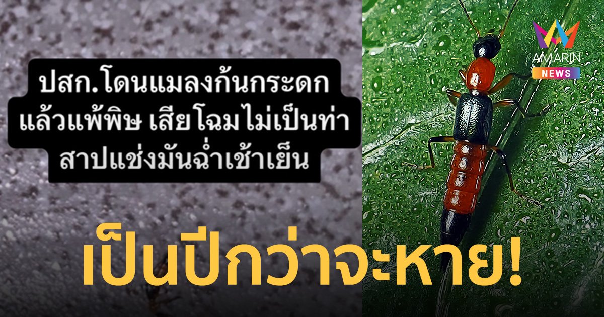 แมลงก้นกระดก สัตว์มีพิษอาละวาดหน้าฝน สาวโดนกัดแผลเหวอะ จากขาลามหน้า