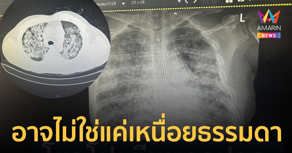 โรคโปรตีนพอกปอด หมอเผยเคส คนไข้มีอาการเหนื่อยหอบ 3 ปี เอกซเรย์เจอฝ้าเต็มปอด