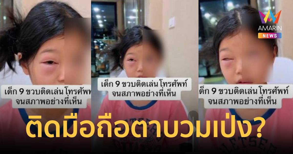 โซเชียลเสียงแตก เด็ก 9 ขวบ เล่นมือถือจนสภาพเป็นแบบนี้