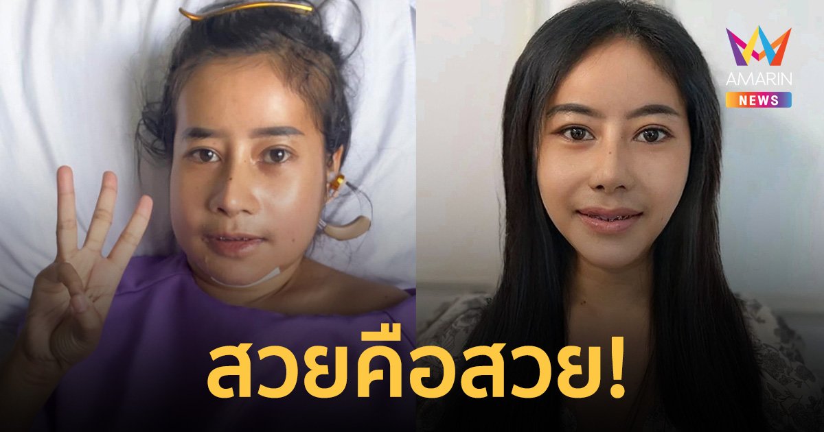 หนูรัตน์ หน้าใหม่ ผ่าตัดเลื่อนขากรรไกร ขนาดยังไม่เข้าที่ก็ฉ่ำเวอร์ เกาหลีเกาใจ