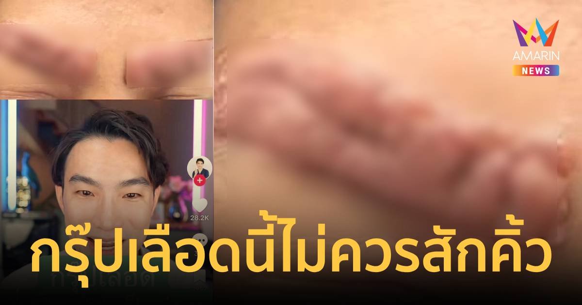 สายเสริมความงามต้องรู้ กรุ๊ปเลือดไหนเป็นแผลง่าย